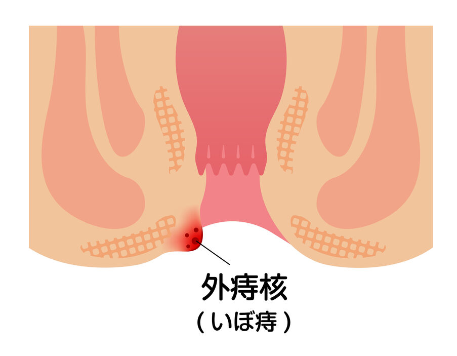 外痔核