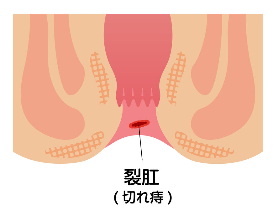 切れ痔