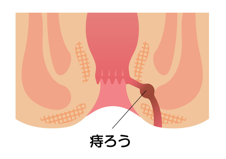 痔ろう