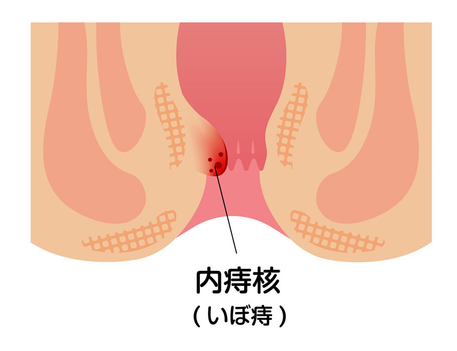内痔核